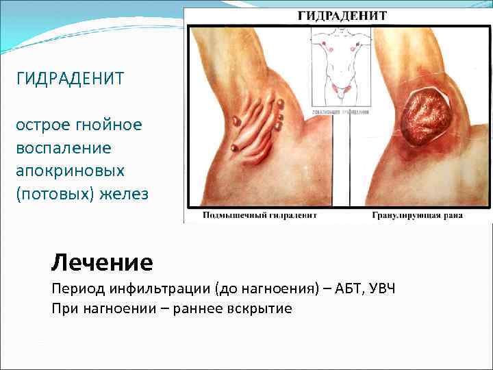 ГИДРАДЕНИТ острое гнойное воспаление апокриновых (потовых) желез Лечение Период инфильтрации (до нагноения) – АБТ,