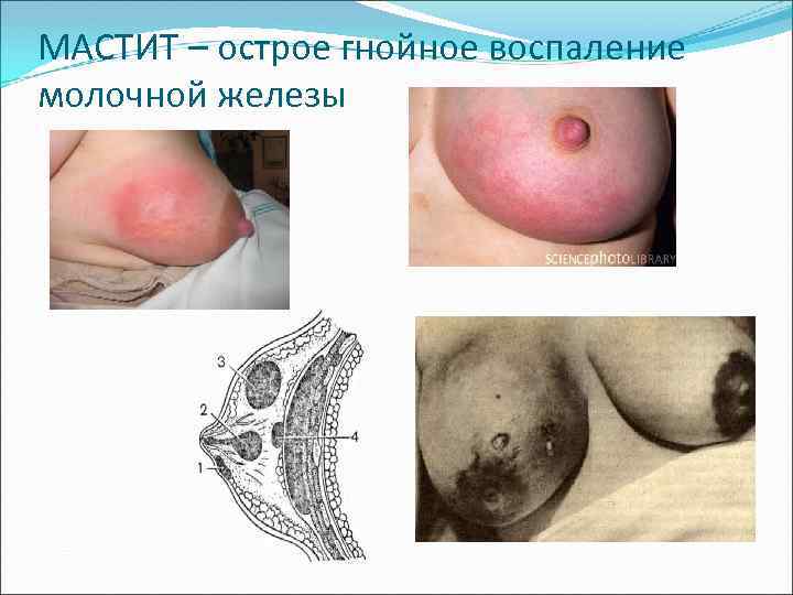 МАСТИТ – острое гнойное воспаление молочной железы 