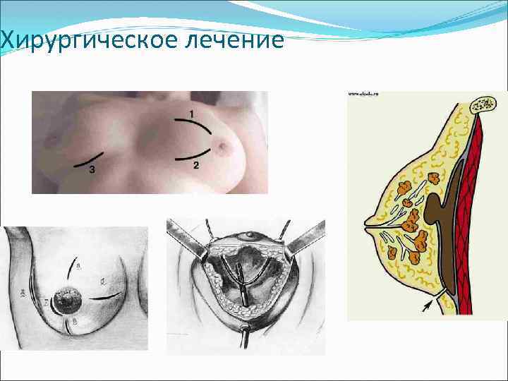Хирургическое лечение 