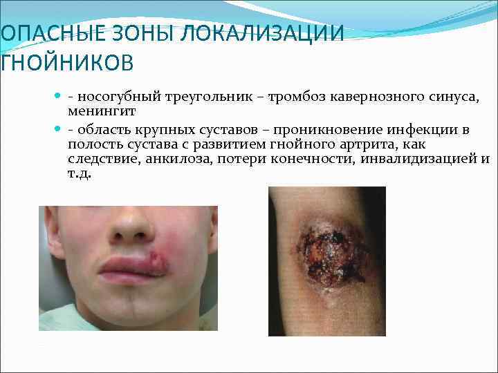 ОПАСНЫЕ ЗОНЫ ЛОКАЛИЗАЦИИ ГНОЙНИКОВ - носогубный треугольник – тромбоз кавернозного синуса, менингит - область