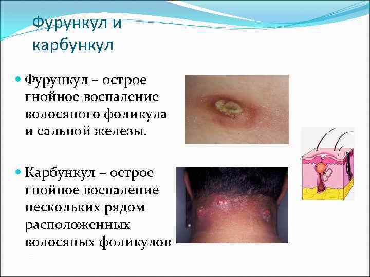 Фурункул и карбункул Фурункул – острое гнойное воспаление волосяного фоликула и сальной железы. Карбункул