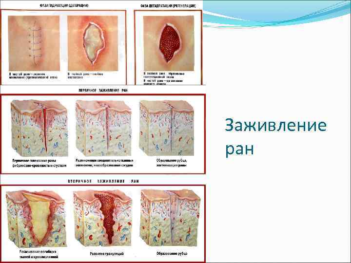 Заживление ран 