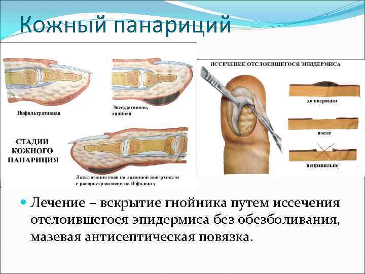 Кожный панариций Лечение – вскрытие гнойника путем иссечения отслоившегося эпидермиса без обезболивания, мазевая антисептическая