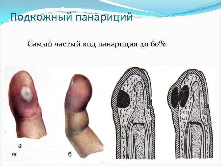 Подкожный панариций Самый частый вид панариция до 60% 