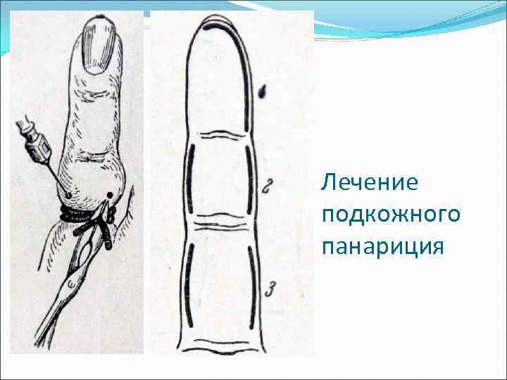 Лечение подкожного панариция 