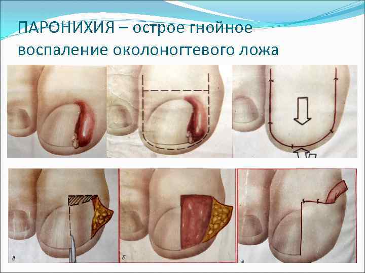 ПАРОНИХИЯ – острое гнойное воспаление околоногтевого ложа 