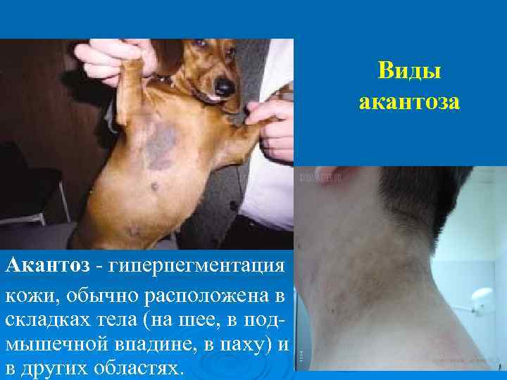 Виды акантоза Акантоз - гиперпегментация кожи, обычно расположена в складках тела (на шее, в