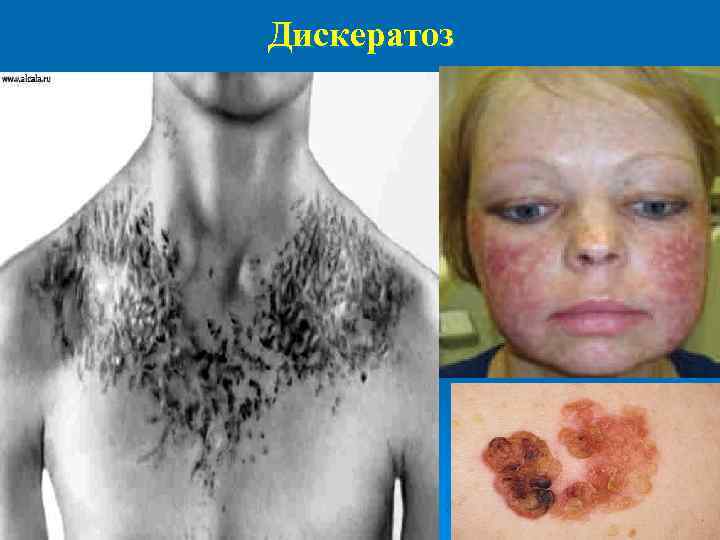 Дискератоз 