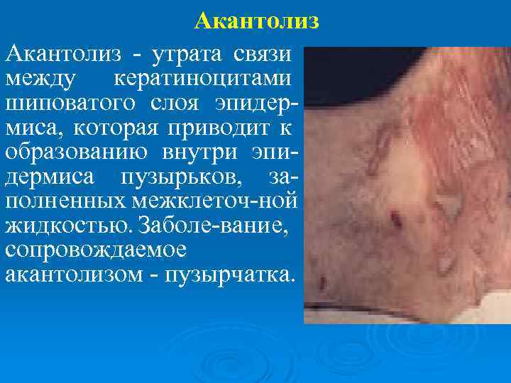 Акантолиз - утрата связи между кератиноцитами шиповатого слоя эпидермиса, которая приводит к образованию внутри