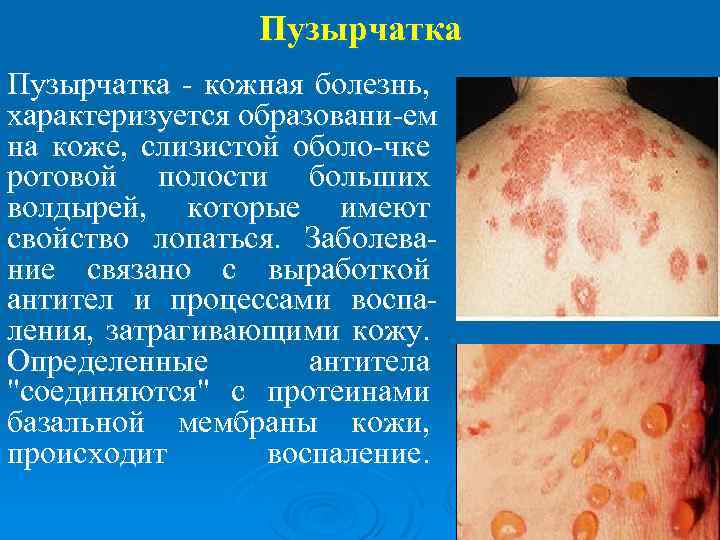 Пузырчатка - кожная болезнь, характеризуется образовани-ем на коже, слизистой оболо-чке ротовой полости больших волдырей,