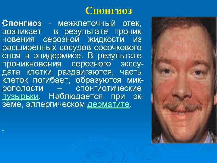Спонгиоз - межклеточный отек, возникает в результате проникновения серозной жидкости из расширенных сосудов сосочкового