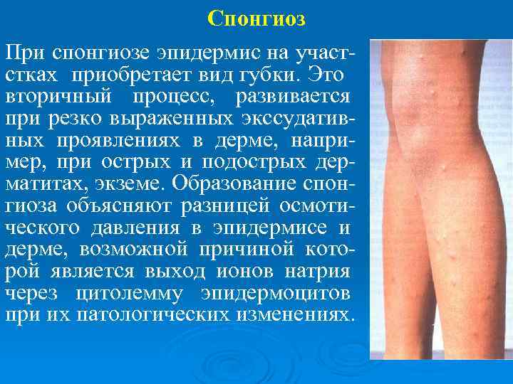 Спонгиоз При спонгиозе эпидермис на участстках приобретает вид губки. Это вторичный процесс, развивается при