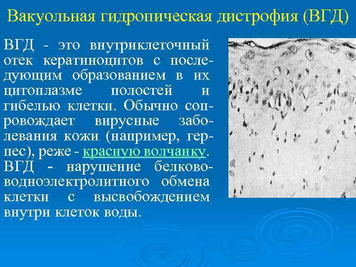 Вакуольная гидропическая дистрофия (ВГД) ВГД - это внутриклеточный отек кератиноцитов с последующим образованием в