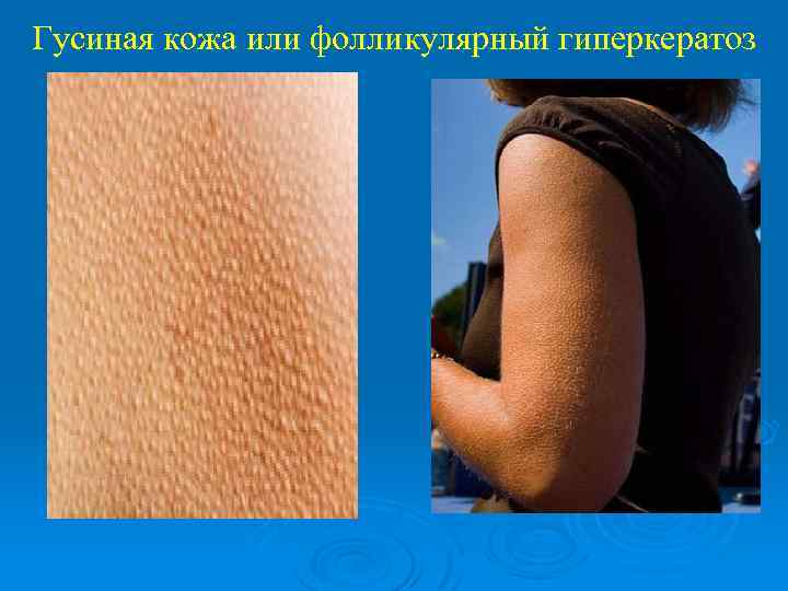 Гусиная кожа или фолликулярный гиперкератоз 