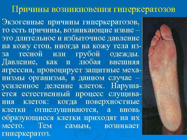 Причины возникновения гиперкератозов Экзогенные причины гиперкератозов, то есть причины, возникающие извне – это длительное