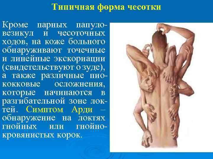 Типичная форма чесотки Кроме парных папуловезикул и чесоточных ходов, на коже больного обнаруживают точечные