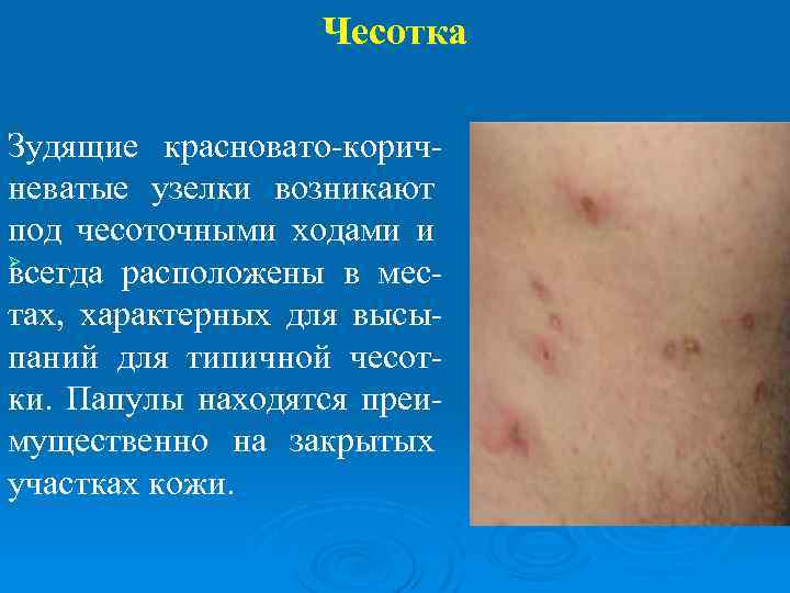 Чесотка Зудящие красновато-коричневатые узелки возникают под чесоточными ходами и Ø всегда расположены в местах,