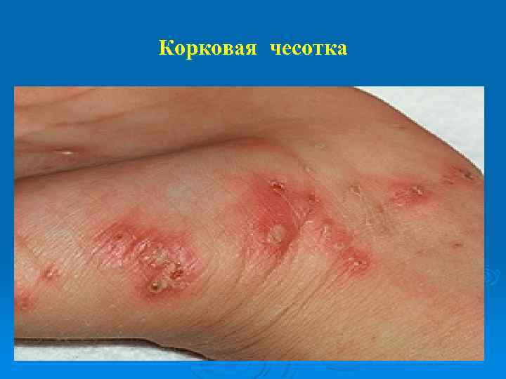 Корковая чесотка 