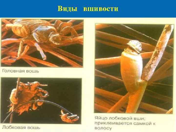 Виды вшивости 