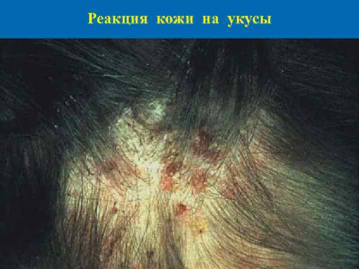 Реакция кожи на укусы 