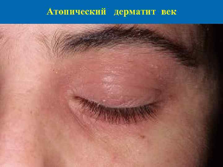 Атопический дерматит век 