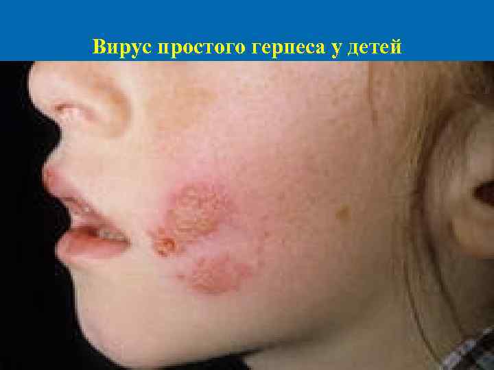 Вирус простого герпеса у детей 