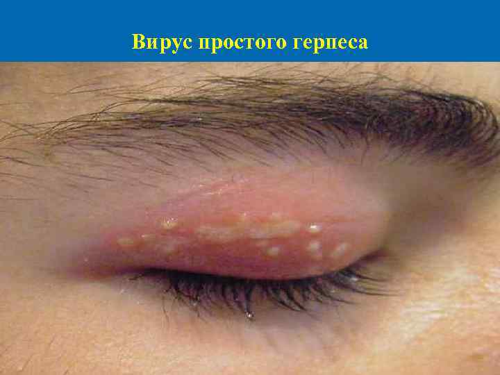 Вирус простого герпеса 