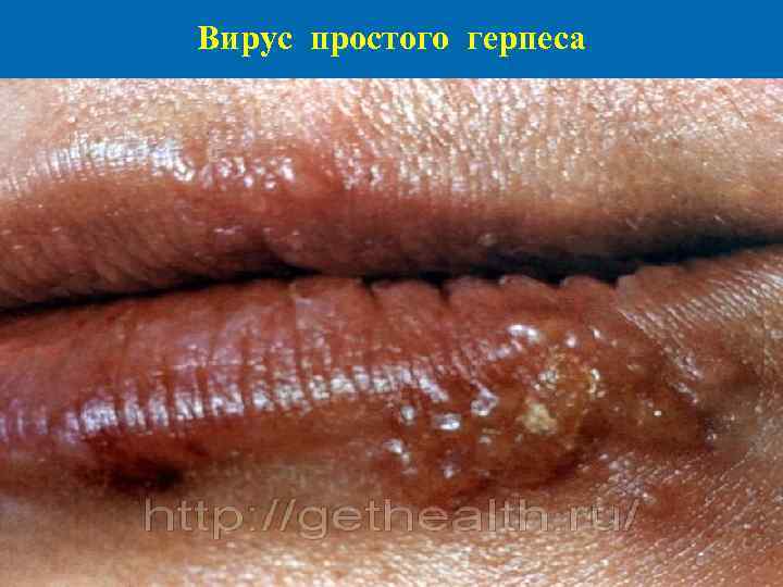 Вирус простого герпеса 