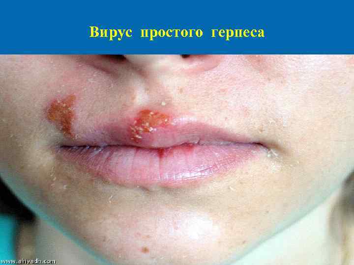 Вирус простого герпеса 