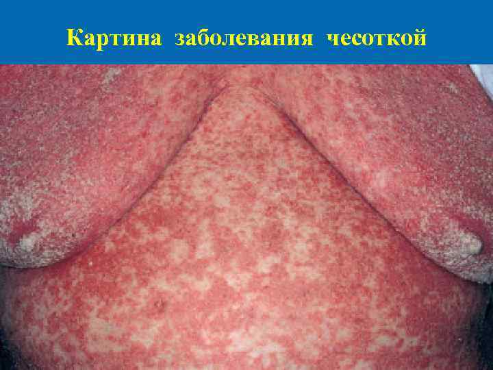 Картина заболевания чесоткой 