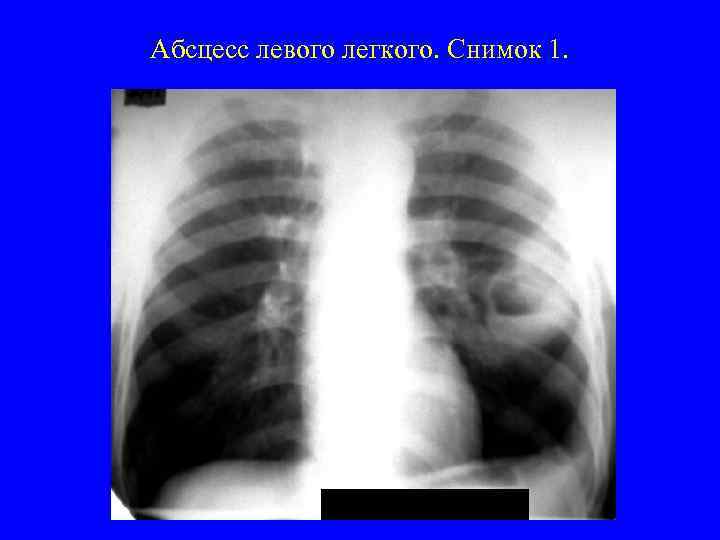 Абсцесс левого легкого. Снимок 1. 