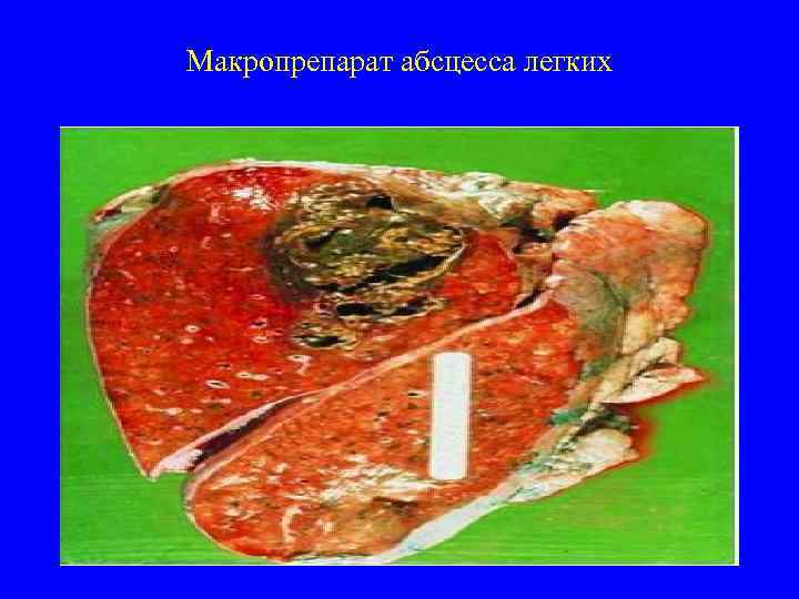 Макропрепарат абсцесса легких 