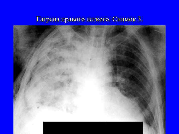 Гагрена правого легкого. Снимок 3. 
