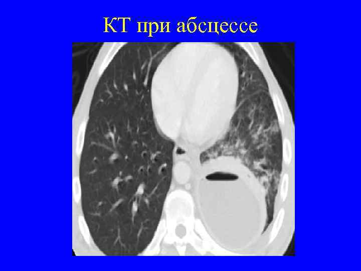 КТ при абсцессе 