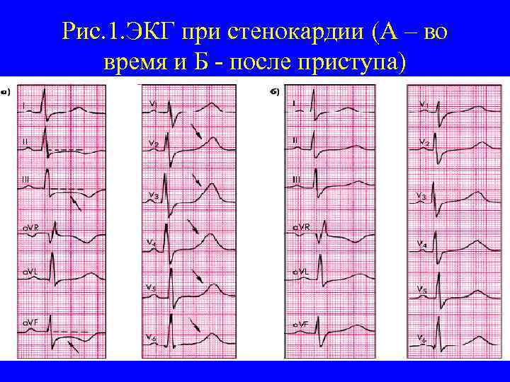 Рис. 1. ЭКГ при стенокардии (А – во время и Б - после приступа)