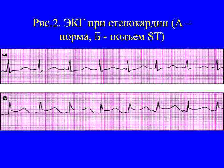 Рис. 2. ЭКГ при стенокардии (А – норма, Б - подъем ST) 