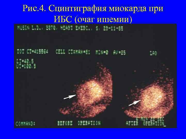 Рис. 4. Сцинтиграфия миокарда при ИБС (очаг ишемии) 