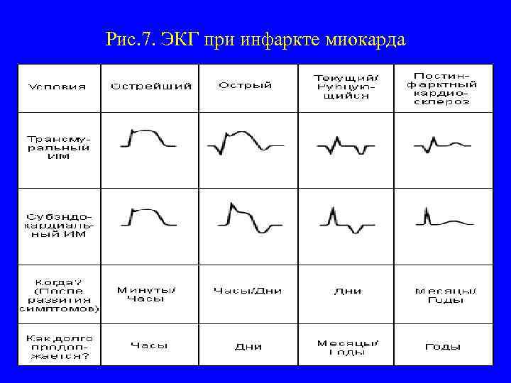 Рис. 7. ЭКГ при инфаркте миокарда 