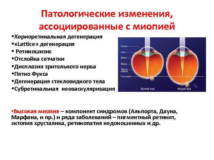  Патологические изменения, ассоциированные с миопией §Хориоретинальная дегенерация § «Lattice» дегенерация § Ретиношизис §Отслойка