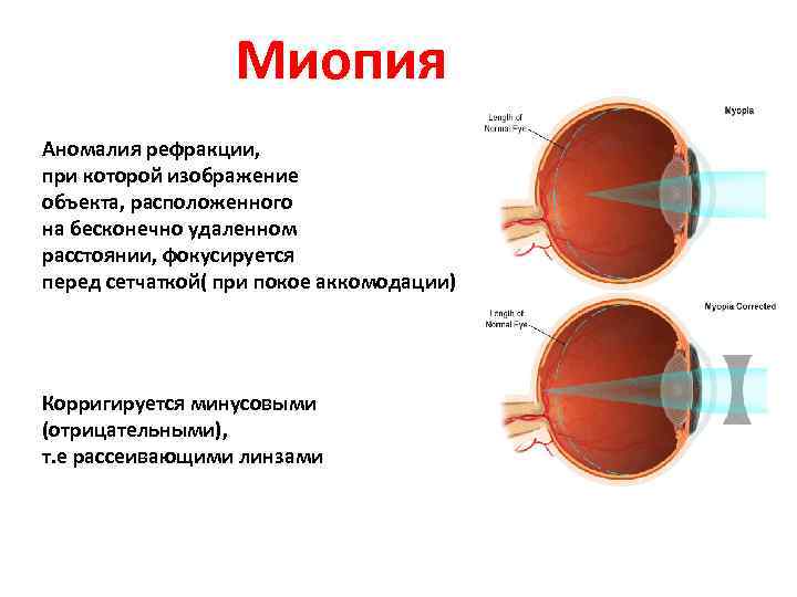  Миопия Аномалия рефракции, при которой изображение объекта, расположенного на бесконечно удаленном расстоянии, фокусируется