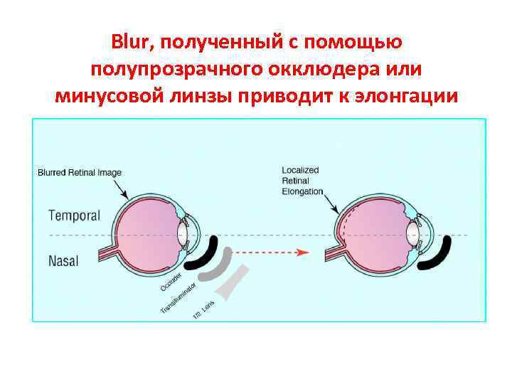  Blur, полученный с помощью полупрозрачного окклюдера или минусовой линзы приводит к элонгации 
