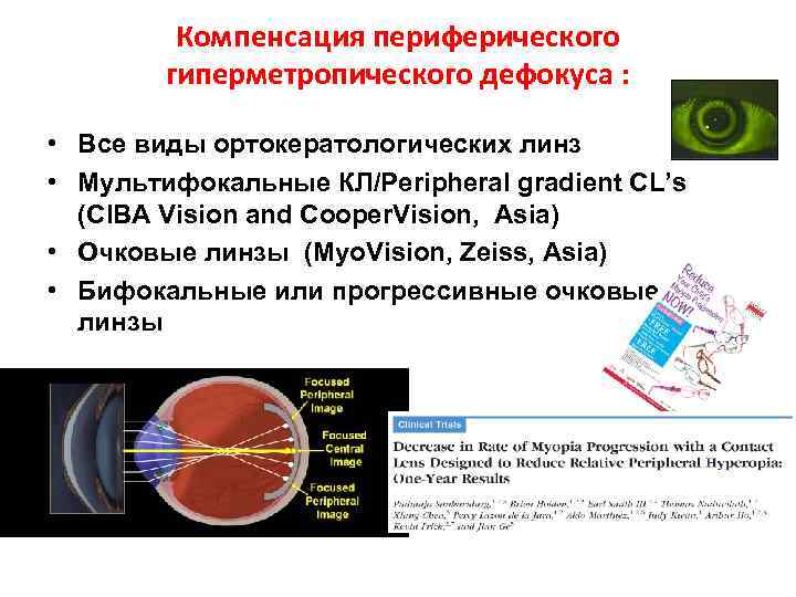  Компенсация периферического гиперметропического дефокуса : • Все виды ортокератологических линз • Мультифокальные КЛ/Peripheral