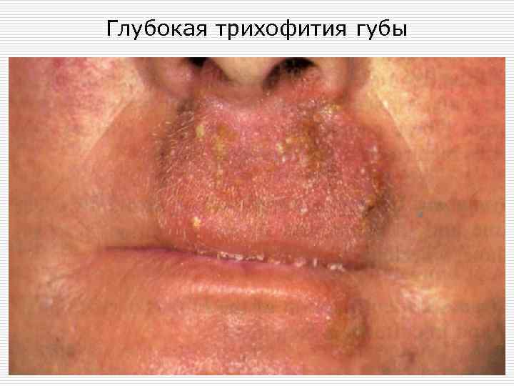 Глубокая трихофития губы 