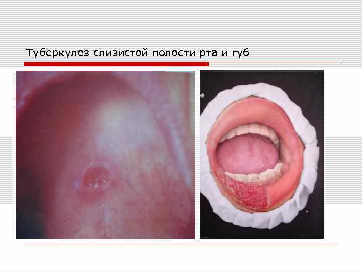Туберкулез слизистой полости рта и губ 