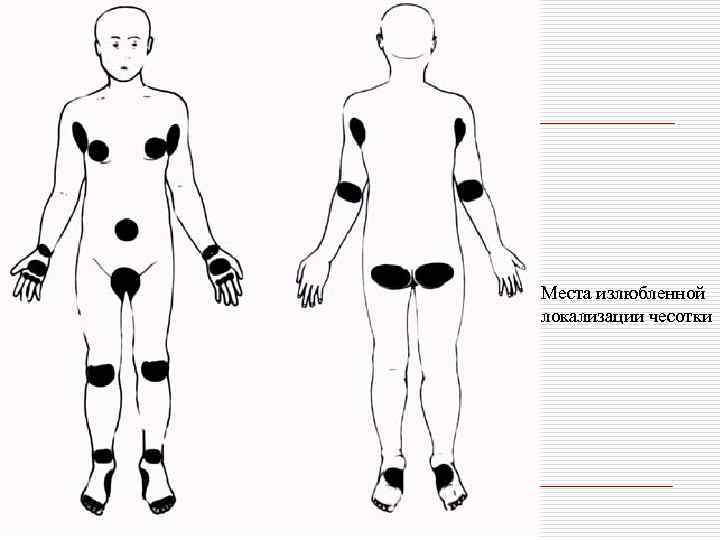 Места излюбленной локализации чесотки 