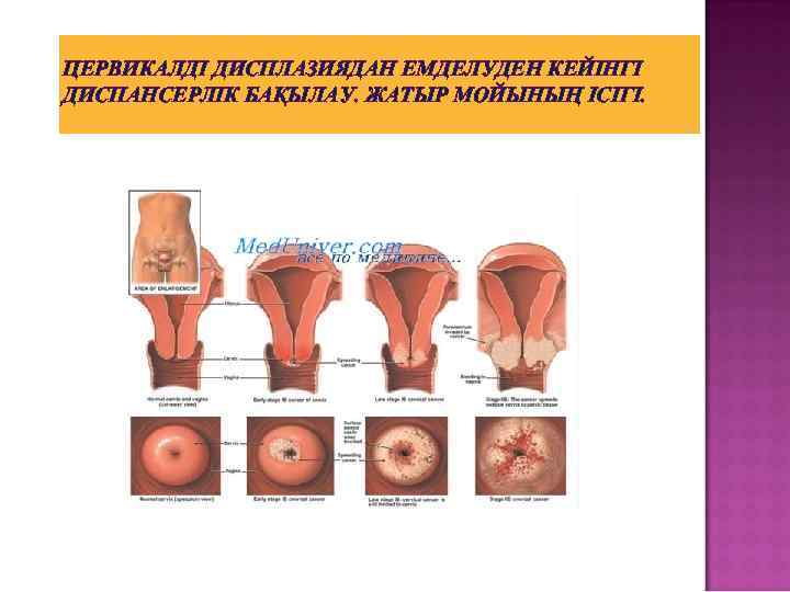 ЦЕРВИКАЛДІ ДИСПЛАЗИЯДАН ЕМДЕЛУДЕН КЕЙІНГІ ДИСПАНСЕРЛІК БАҚЫЛАУ. ЖАТЫР МОЙЫНЫҢ ІСІГІ. 