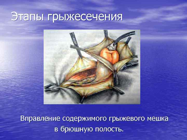 Этапы грыжесечения Вправление содержимого грыжевого мешка в брюшную полость. 