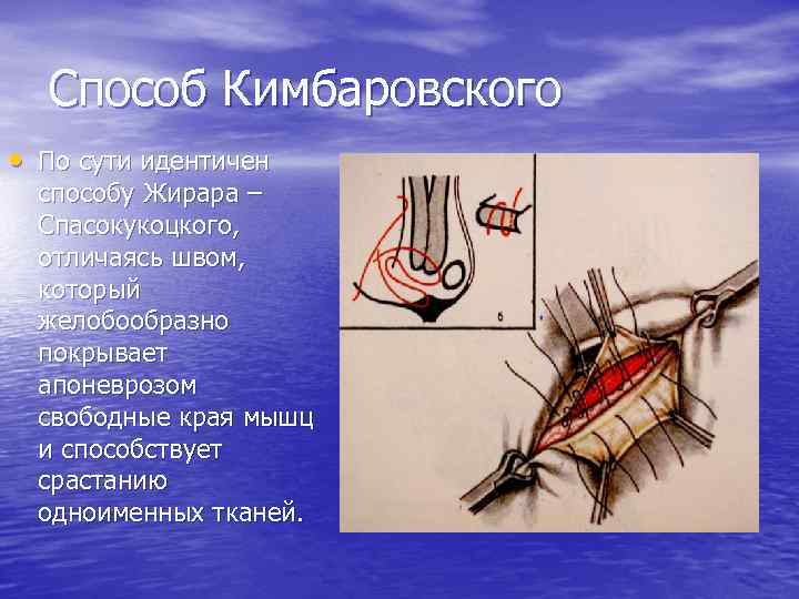 Способ м. Операция Жирара-Спасокукоцкого со швами Кимбаровского. Грыжесечение Кимбаровскому. Пластика грыжи по Жирару Спасокукоцкому Кимбаровскому. Жирару Спасокукоцкому со швом Кимбаровского.