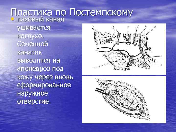 Пластика стенок. Герниопластика Постемпского. Пластика по Бассини Постемпскому. Грыжесечение по Постемпскому. Герниопластика по Бассини-ПОСТЕМСКИ.