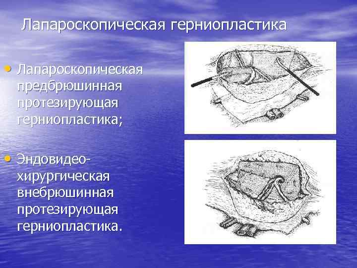 Грыжи факультетская хирургия презентация